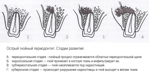 Острый гнойный периодонтит