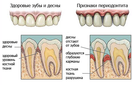 Инфекционный периодонтит