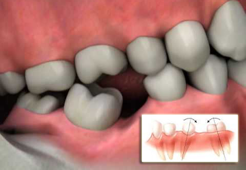 Аномалии зубных рядов