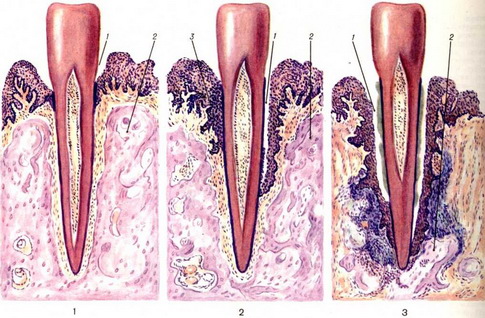 Классификация пародонтоза по А. Евдокимову