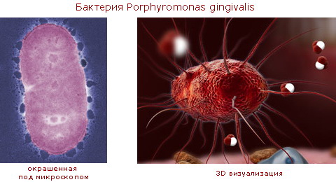 Бактерия  Porphyromonas gingivalis производит фермент peptidylarginine deiminanse (PAD) 