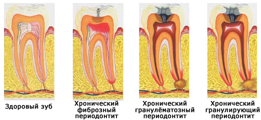 Хронический периодонтит