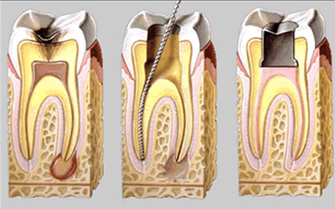 Пульпит - лечение