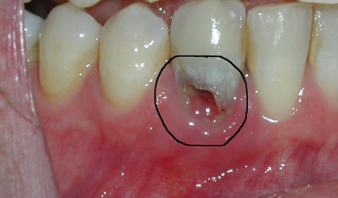 Резорбция зуба