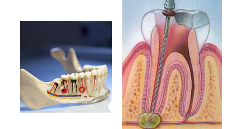 Лечение каналов зуба