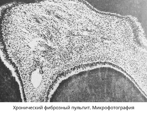 Фиброзный пульпит