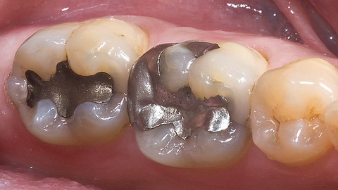 Металлические зубные пломбы (Амальгама)