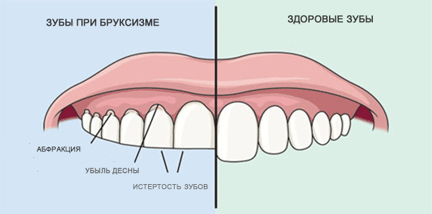 Бруксизм