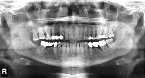 Рентгеноанатомия челюсти