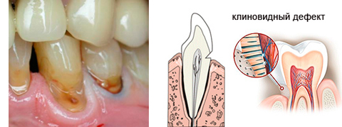 Клиновидный дефект зуба
