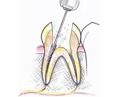 Перепломбировка каналов зуба