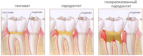 Заболевания пародонта