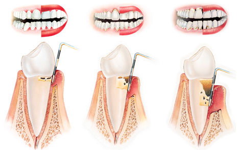 Виды пародонтита 