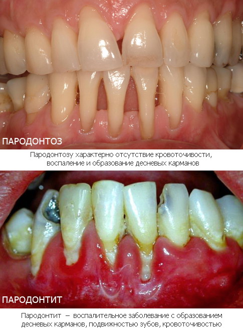 Пародонтоз