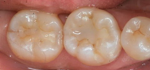 Цементные зубные пломбы