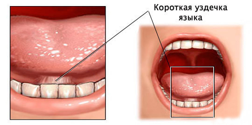 Короткая уздечка языка